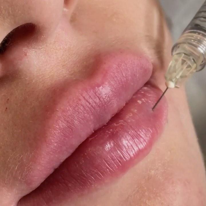 Контурная пластика губ в косметологии