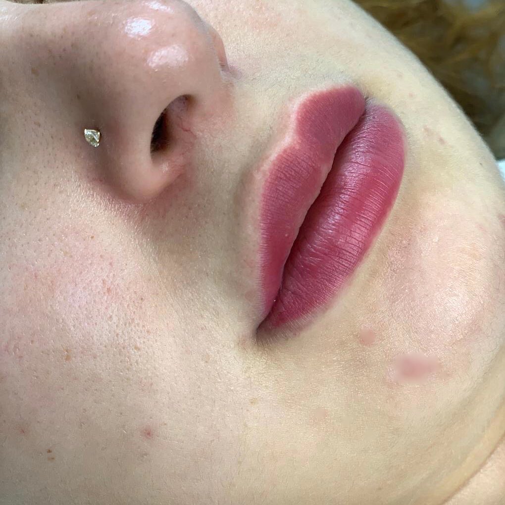 Красивые увеличенные губы после процедуры